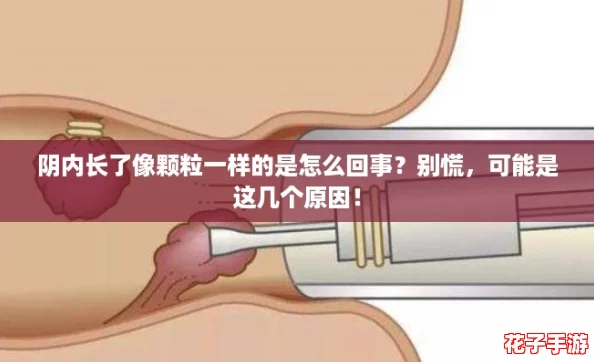 阴内长了像颗粒一样的是怎么回事?别慌,可能是这几个原因! 阴内长了像颗粒一样的是怎么回事?别慌,可能是这几个原因!