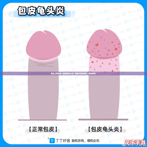 龟头上有白皮一搓就掉怎么治?解锁护肤新技能,告别烦恼! 龟头上有白皮一搓就掉怎么治?解锁护肤新技能,告别烦恼!