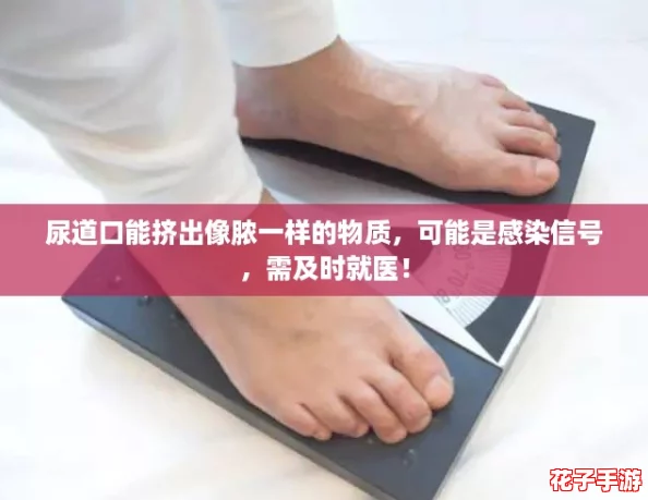 尿道口能挤出像脓一样的物质，可能是感染信号，需及时就医！