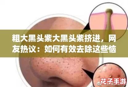 粗大黑头紫大黑头紫挤进，网友热议：如何有效去除这些恼人的肌肤问题？