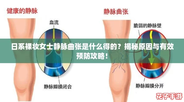 日系裸妆女士静脉曲张是什么得的？揭秘原因与有效预防攻略！